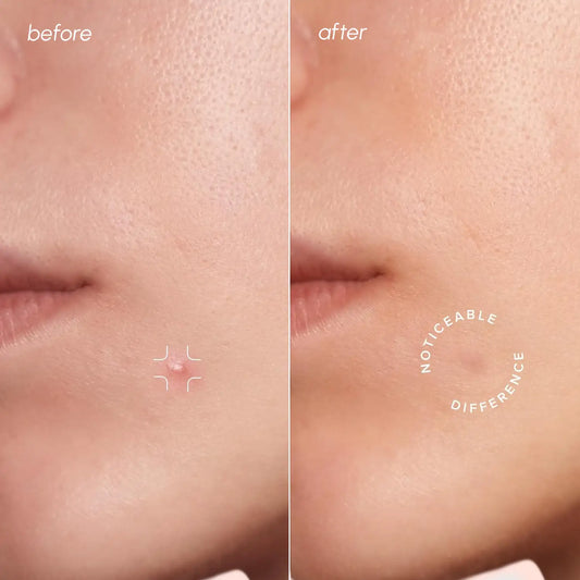 Invisible Pimple & Acne Patches